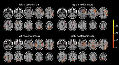 Damaged Insula Network Contributes to Depression in Parkinson’s Disease